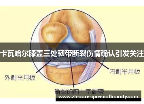 卡瓦哈尔膝盖三处韧带断裂伤情确认引发关注
